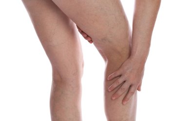 Beyaz arka planda varisli damarlardan muzdarip bir kadın, yakın plan.