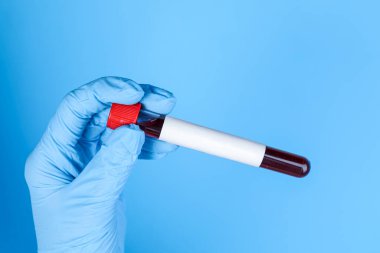 Laboratuvar çalışanı elinde kan örneğiyle test tüpü tutuyor ve açık mavi arka planda boş etiket, yakın plan. Tıbbi analiz