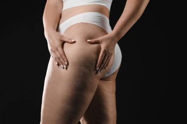 Siyah arka planda selüliti olan kadın, yakın plan. Metin için boşluk