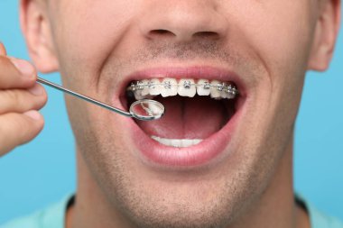 Açık mavi arka planda ayna aracı kullanarak diş telleri ile insan dişlerinin incelenmesi, yakın plan
