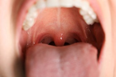 Kadının ağız boşluğunun yakın görüntüsü. Boğaz ağrısı.