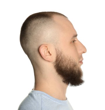 Kellik sorunu. Beyaz arka planda ince çizgili bir adam.