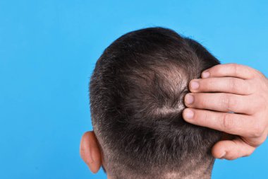Kellik sorunu. Kel, açık mavi arka planda, arka manzaralı. Metin için boşluk