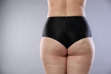 Açık gri arka planda selüliti olan kadın, yakın plan. Metin için boşluk