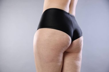 Açık gri arka planda selüliti olan kadın, yakın plan.