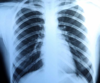 Göğüs kafesinin arkaplan olarak X-ray görüntüsü, yakın plan