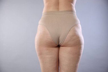 Açık gri arka planda selüliti olan kadın, yakın plan.