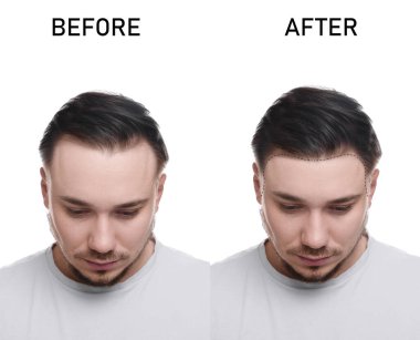 Beyaz arka planda kellikten muzdarip bir adam. Tedavi öncesi ve sonrası fotoğraflarla kolaj