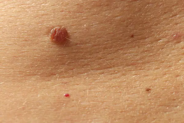 Teninde benler olan bir adam, yakın plan.