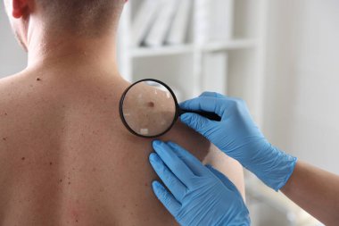 Hastanedeki adamın köstebeklerini inceleyen doktor, yakın plan. Metin için boşluk