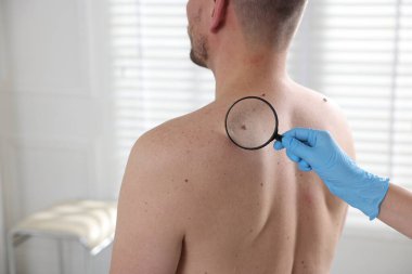 Hastanedeki adamın köstebeklerini inceleyen doktor, yakın plan. Metin için boşluk