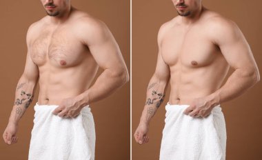 Kahverengi arka planda epilasyon işleminden önce ve sonra göğüs röntgeni, yakın plan. Fotoğraf Kolajı