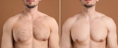 Man showing chest before and after epilation procedure on brown background, closeup. Collage of photos