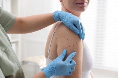 Hastanede kadının köstebeklerini inceleyen doktor, yakın plan.