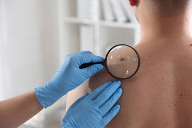 Hastanedeki adamın köstebeklerini inceleyen doktor, yakın plan. Metin için boşluk