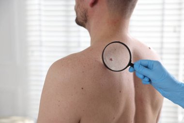 Hastanedeki adamın köstebeklerini inceleyen doktor.