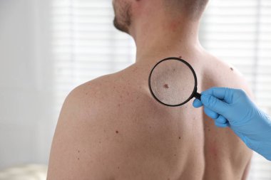 Hastanedeki adamın köstebeklerini inceleyen doktor.