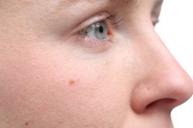 Yüzünde ben olan kadın beyaz arka planda, yakın plan.