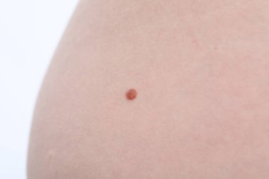 Beyaz arka planda benli bir kadın, yakın plan.