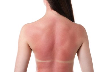 Beyaz arka planda güneş yanığı olan kadın.