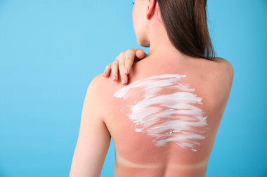 Güneş yanığı cildinde güneş koruyucu maddesi olan bir kadın açık mavi arka planda, arka planda. Metin için boşluk