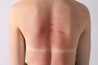 Güneş yanığından derisi soyulmuş kadın, yakın plan.