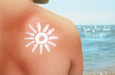 Sahilde güneş yanığı olan bir adam, arka manzara. Vücudunda güneş şeklinde sakinleştirici krem.