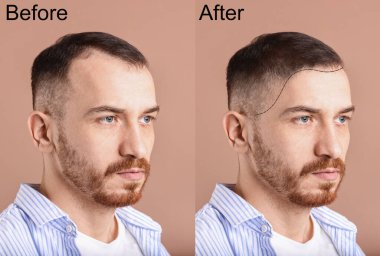 Bej pembe arka planda saç tedaviden önce ve sonra adam, kolaj