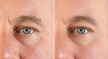 Cilt bakımından önce ve sonra yüzünü gösteren adam, yakın plan. Kolaj