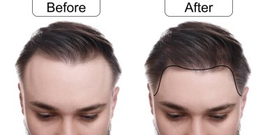 Beyaz arka planda saç tedavisi öncesi ve sonrası adam, kolaj