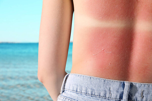 Woman with sunburned skin against sea, back view