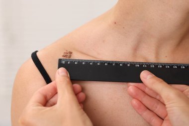 Doktor hastanede Cetvel ile genç kadının köstebeğini inceliyor.