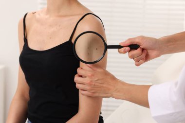 Hastanede büyüteçle genç kadının benini inceleyen doktor, yakın plan.