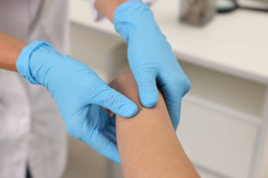 Hastanede genç bir kadının köstebeğini muayene eden doktor, yakın plan.