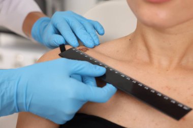 Doktor hastanede Cetvel ile genç kadının köstebeğini inceliyor.