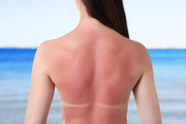 Женщина с обгорелой кожей на берегу моря, вид сзади