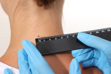 Doktor, beyaz arka planda cetvelle genç kadının benini inceliyor.