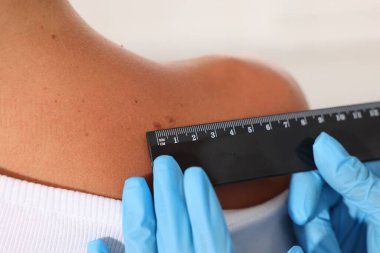 Doktor, beyaz arka planda cetvelle genç kadının benini inceliyor.