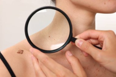 Hastanede büyüteçle genç kadının benini inceleyen doktor, yakın plan.