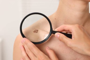 Hastanede büyüteçle genç kadının benini inceleyen doktor, yakın plan.