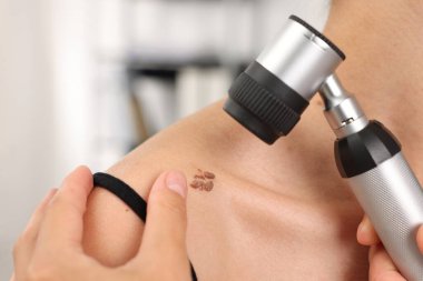 Doktor hastanede dermatoskopla genç kadının benini inceliyor.