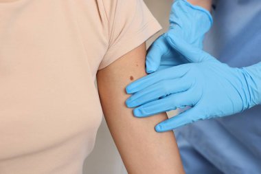 Hastanede genç bir kadının köstebeğini muayene eden doktor, yakın plan.