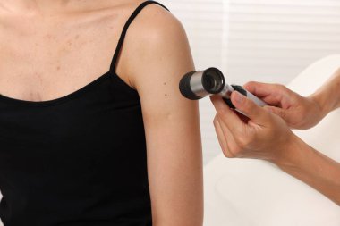 Doktor hastanede dermatoskopla genç kadının benini inceliyor.