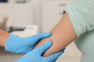 Hastanede genç bir kadının köstebeğini muayene eden doktor, yakın plan.