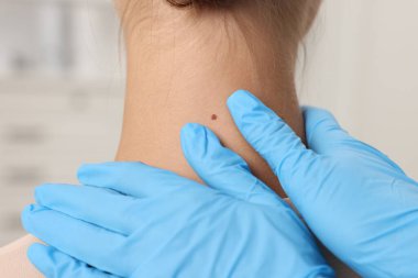 Hastanede genç bir kadının köstebeğini muayene eden doktor, yakın plan.