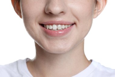 Beyaz arka planda diş hizalama tedavisinden sonra gülümseyen kadın, yakın plan