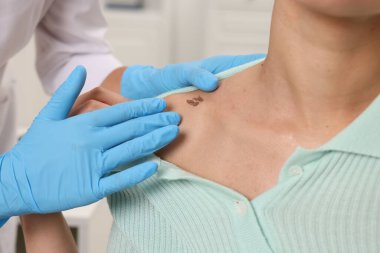 Hastanede genç bir kadının köstebeğini muayene eden doktor, yakın plan.