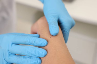 Hastanede genç bir kadının köstebeğini muayene eden doktor, yakın plan.