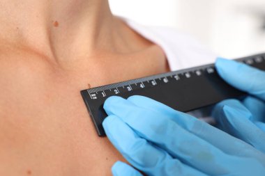 Doktor, beyaz arka planda cetvelle genç kadının benini inceliyor.