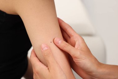 Hastanede genç bir kadının köstebeğini muayene eden doktor, yakın plan.